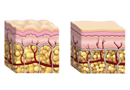 La Cellulite